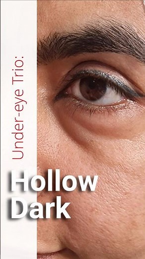 EZ Gel, Biofiller (Autologous) Under-eye Hollowness Treatment Procedure! #ezgel #undereyes