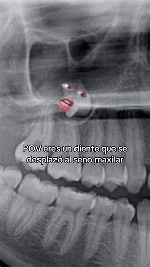 El desplazamiento de un diente hacia el seno maxilar es una complicación que puede ocurrir durante una extracción dental si no se realiza una técnica quirúrgica correcta 🦷🥴 Generalmente las raíces dentales o el diente completo pueden ser removidos por un abordaje bajo anestesia local. Agenda tu cita 🦷 en📍Tijuana 📱6643105906 🇲🇽/6192098812 🇺🇸 Aceptamos seguro dental PPO ✅ Dra Ilse Alcina Tostado UABC-CP: 8676935 COFEPRIS: 240202200A00083 #muelasdeljuicio #dentistaentijuana #dentalinsuranc