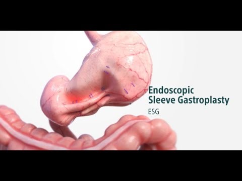 Endoscopic Sleeve Gastroplasty (ESG) Animation