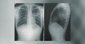 Spectrum Health explains the benefits of Pulmonary Rehab