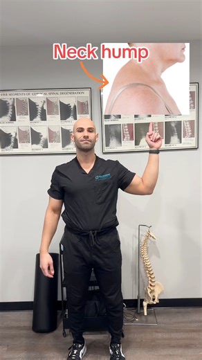 95K views · 616 reactions | Neck hump? Try this neck hump stretch and SHARE! Neck humps can have various causes such as Cushing’s Syndrome. If it’s due to posture, this stretch may help! #neckhump #neckhumpfix #posture #forwardheadposture #techneck #tips | Prime Performance Chiropractic & Wellness Clinic | Facebook