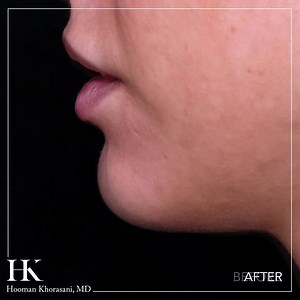 Dr. Khorasani’s Chin Augmentation with Dermal Filler