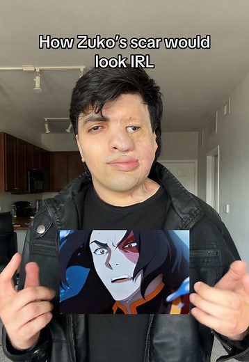 Zuko's Scar IRL: A Burn Survivor's Reality