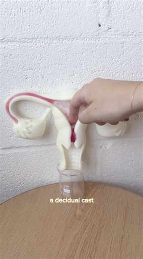 Decidual casts - one of menstruation's most dramatic and rarely discussed phenomena. When the entire uterine lining sheds intact as a decidual cast, it can be shocking yet reveals important truths about hormonal influences on the endometrium. Sharing because awareness matters and too many face this experience without preparation or understanding. No bodily process should leave you feeling isolated or afraid. Let's normalise these conversations. Click the link in bio to read more on Decidual Cast