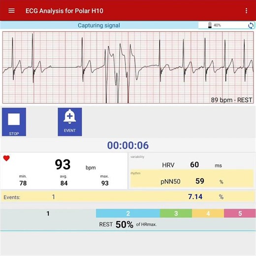 Ventricular Tachycardia with Polar H10 | ECG Analysis App for Athletes & Rehab