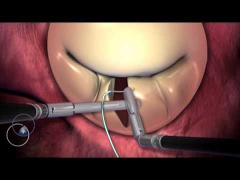 Robotic Mitral Valve Repair