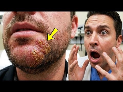 Man Thought It Was Just a Patch in His Beard — Until Doctors Took It Seriously