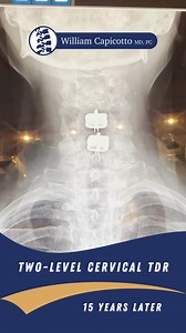 36 reactions | Patients understand that disc replacement is a great...