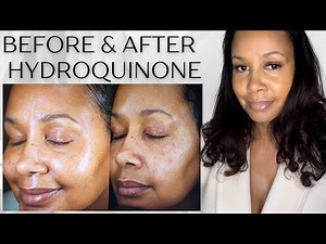 Triluma Results After 90 Days .