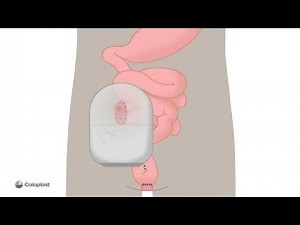 Stomi - Loop-ileostomi og j-formet pose med fjernelse af tyktarm og endetarm