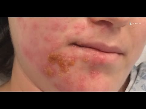 What is Ramsay Hunt Syndrome?