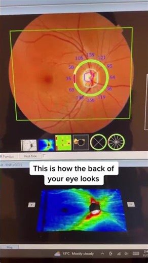 This is an OCT which scans the back of your eyes, did you ever get this test done?#oct #eyecaretips