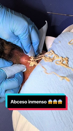 Absceso enorme en la nuca: tratamiento y cuidados