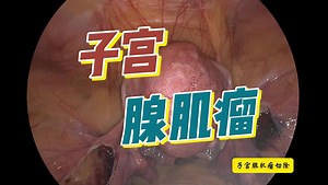 【手术】子宫腺肌瘤切除