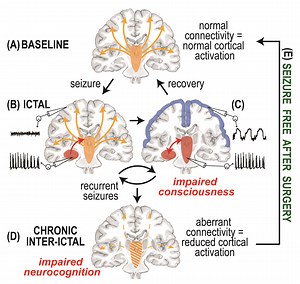 Relating vigilance to connectivity and neurocognition in temporal lobe epilepsy