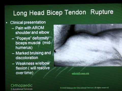 Long Head Biceps Tendon Rupture