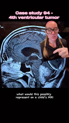 37K views · 877 reactions | Case study 94 - posterior fossa tumor in...