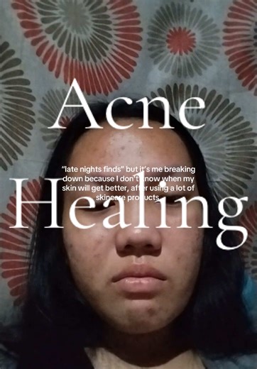 This was me 3 years ago crying because of acne and now my skin is finally healing that’s why always remember that acne is treatable and not for long term ✨ #acnefighter #acneproneskin #glowingskin