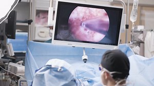 GreenLight™ After UroLift™: Full Procedure