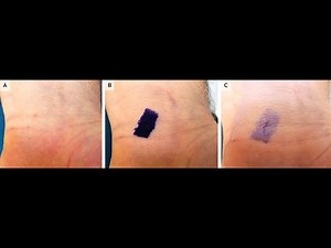 Burrow Ink Test für Scabies