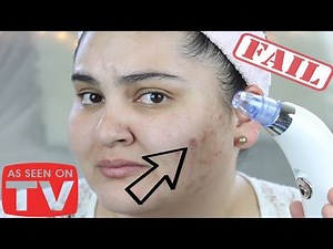 As Seen on TV! Dermasuction Blackhead and Pore Cleaning Tool! WORTH THE PAIN??!