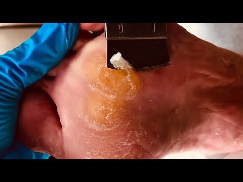 Foot Calluses Explained: Causes, Myths, and Care Tips