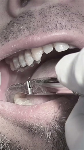 Extraction of wisdom tooth with mobility #dentist