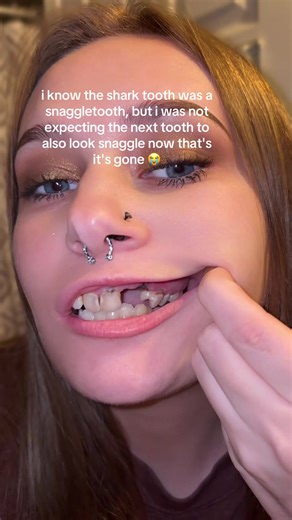 i cannot escape the snaggle #snaggletooth #toothextraction #teethtok #dentaljourney