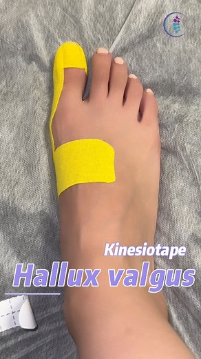Alivia el dolor y mejora la alineación del Hallux Valgus con esta técnica de kinesiotape. 🎯 ¡Ideal para pacientes con juanetes! #Kinesiotaping #HalluxValgus #Fisioterapia #pie | Rehabilitación Segura