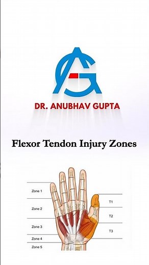 Flexor Tendon Injury Zones Explained | Zones 1 to 5