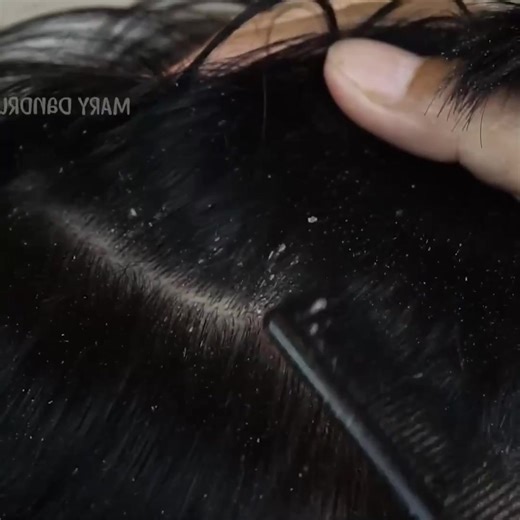 Dandruff scratches in large flakes #52 Part 5 | Hair ticks
