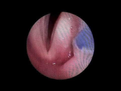 INJECTION LARYNGOPLASTY - LEFT VOCAL FOLD PALSY