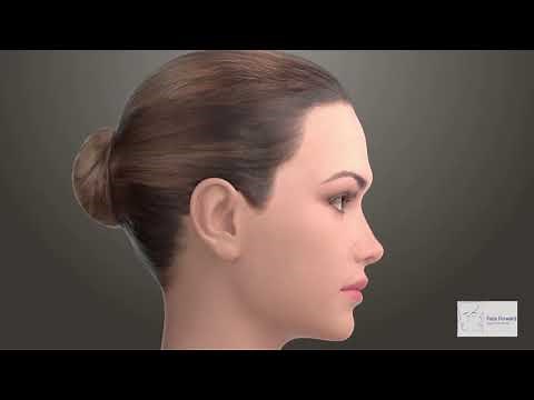 Brow Bossing Explained By Dr. Regina Rodman