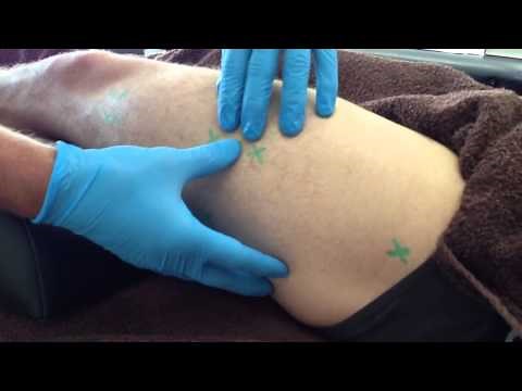 Dry Needling: Vastus Lateralis