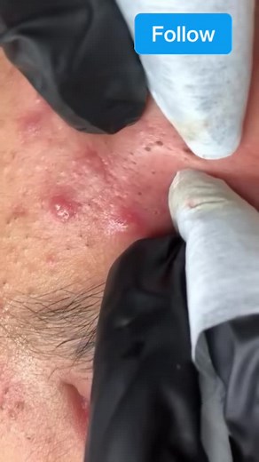 Ultimate Blackheads and Pimple Extractions Compilation