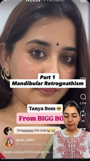 Dr. Poorna Tanwar on Instagram: "Part 1/3 She has done fabulous mimicry , no doubt. Just spreading awareness, no hate ❤️ Full video on my youtube channel Tanya Mittal, bigg boss 19, explore page, reels, Mandibular retrognathism treatment, jaw alignment, overbite correction, facial profile improvement, chin dimpling solution, orthodontic treatment for jaw, lower jaw reposition, mentalis strain fix, puckered chin, dental aesthetics, jaw surgery options, Invisalign for overbite, Class II malocclusi
