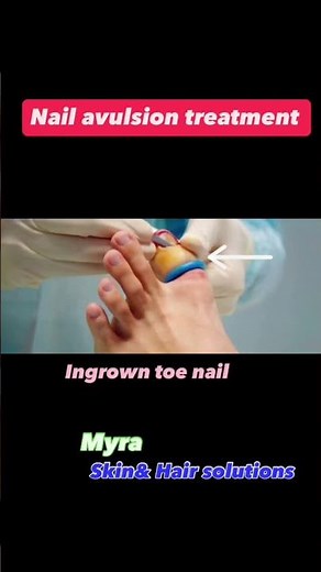 Nail avulsion for ingrown nails #ingrownnailremoval #nailtreatment #nail #dermatologist #skincare