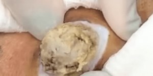 Over 2 Million People Have Viewed This 'Cheesy' Cyst Removal Video