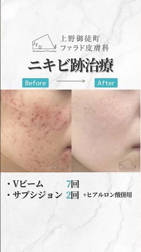 【症例大公開】Vビームでニキビ治療【赤み凹みに】#皮膚科専門医 #美容皮膚科 #美肌ケア #vビーム