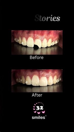 Chipped or fractured front tooth?Composite restoration is a quick and effective way to restore.
