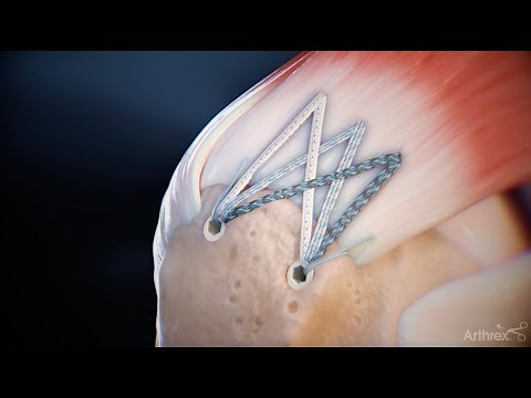 Delaminated Rotator Cuff Repair Surgical Technique Animation