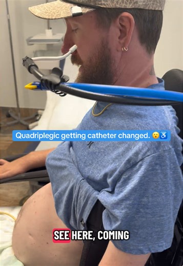 Being paralyzed doesn’t just mean that you can’t walk. It means that you also lose control of your bowel and bladder function (amongst other things) which is quite a hindrance. I use a suprapubic catheter which enters my lower abdomen and goes straight into my bladder so that it can constantly drain out into a leg bag and allow me to actually “go to the bathroom”. Unfortunately it does come at the cost of getting quite frequent UTIs due to having an indwelling catheter at all times growing bacte