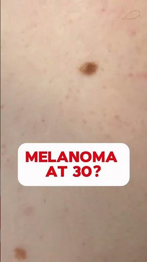 This is melanoma
