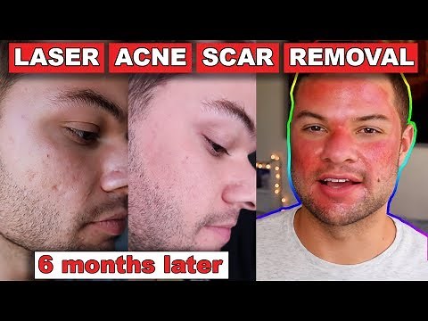 Acne Scar Removal Before And After 6 Months: Fractional C02 Laser Skin Resurfacing