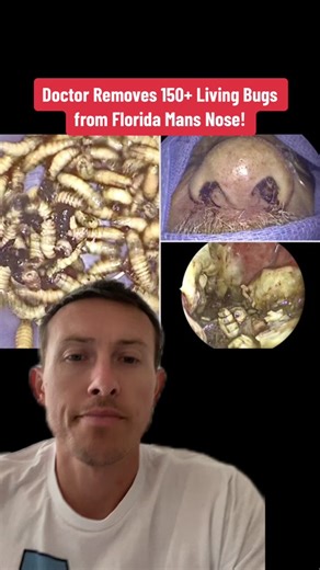 A doctor pulls 150 live bugs out of a mans nose in florida #fyp #foryou #news #viral #xyzbca #what #fears #fear #omg #florida #doctor #strange #medical #jacksonville #nose #larvae #larva #epidemiologist
