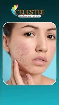 What is Acne Cosmetica? | Why Does It Occur? | #ytshorts #healthtips #acne #skincare #cosmetics