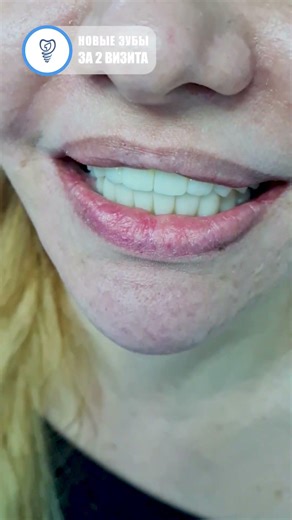 A man regained his youth after ten years of suffering. Dental implants #dentist