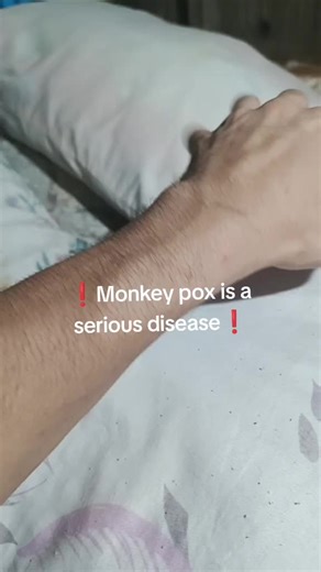 Understanding Monkeypox: Symptoms and Awareness