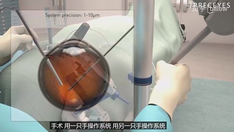 眼科手术机器人preceyes