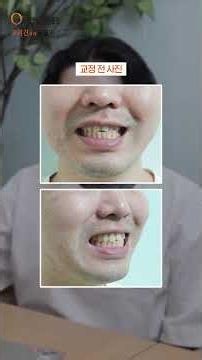 Non-extraction clear aligner review! Improved snaggletooth, protruding mouth, and partial crossbi...